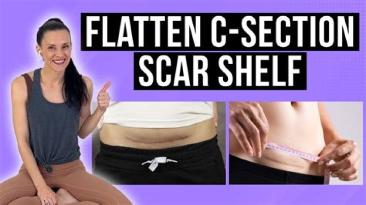 How can I make my C-section shelf go away?