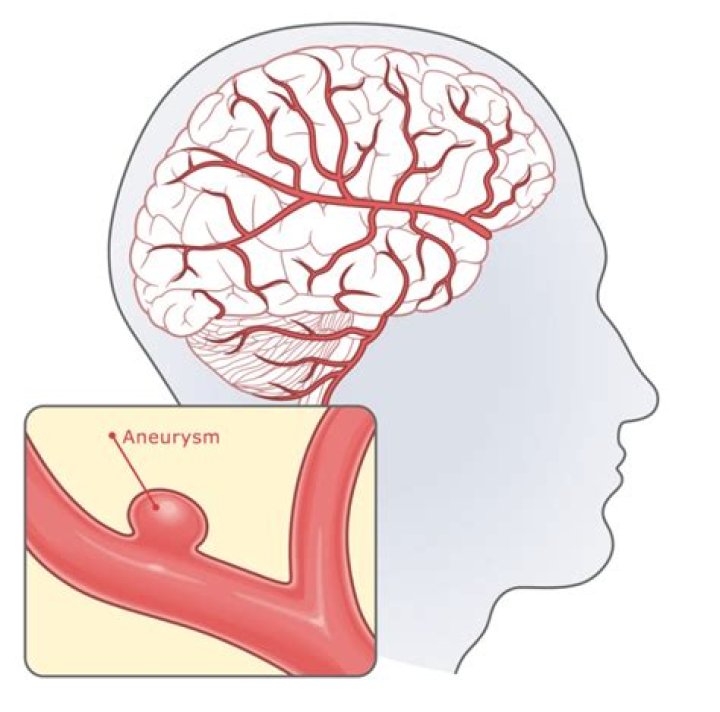 How can you prevent brain aneurysms?