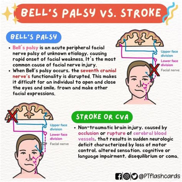 How can you tell the difference between a stroke and Bell's palsy?