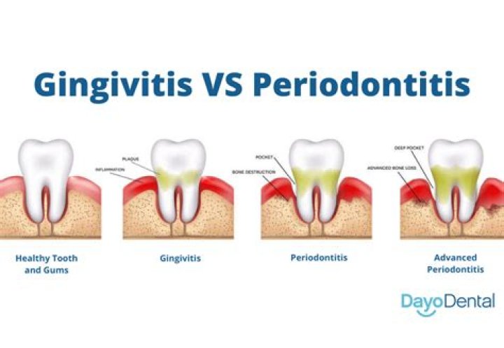 How can you tell the difference between periodontitis and gingivitis?