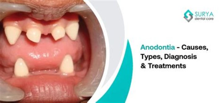 How common is anodontia?
