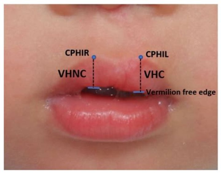 How do I fix vermilion border?