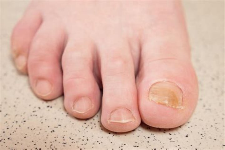 How do I get rid of brown toenails?
