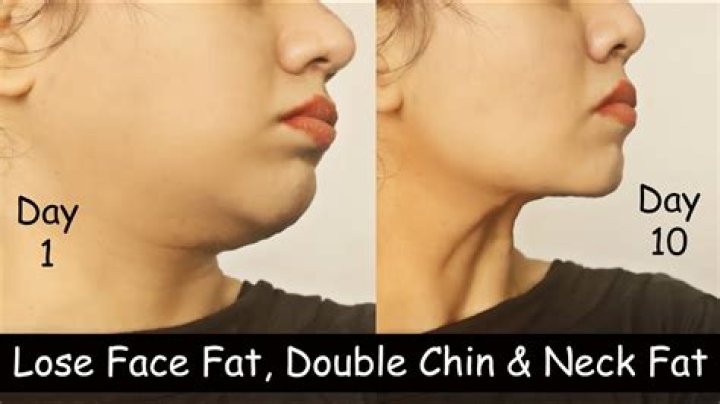 How do I get rid of my chin fat?