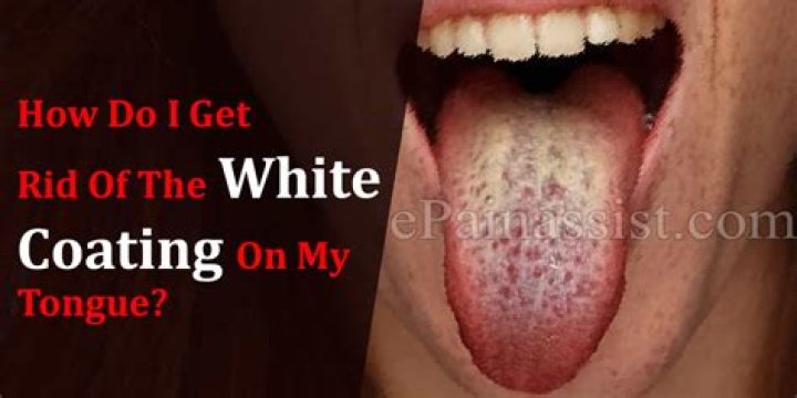 How do I get rid of the white coating on my tongue?