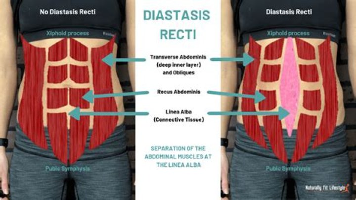 How do I know if I have diastasis recti?