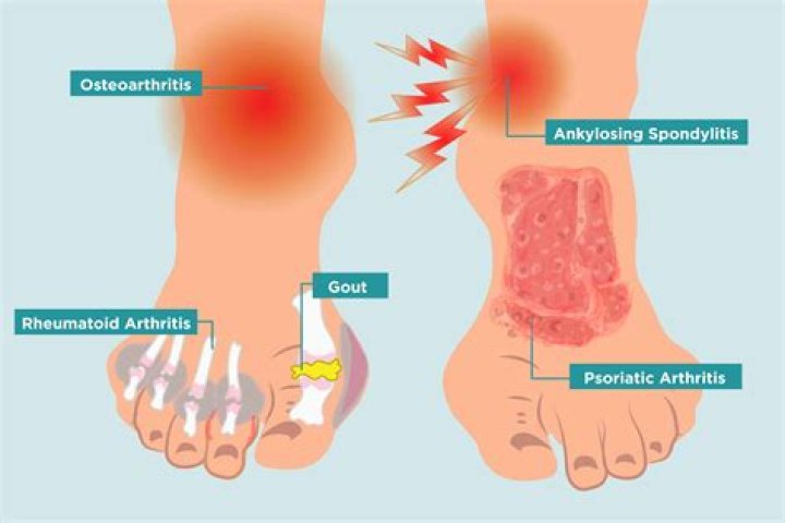 How do I know if I've got arthritis in my toes?