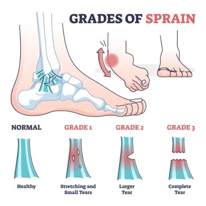 How do I know if my ankle sprain is grade 1 or 2?
