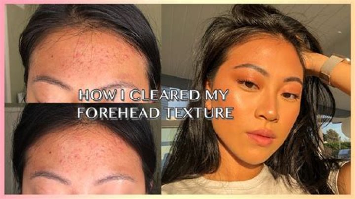 How do I stop forehead acne?