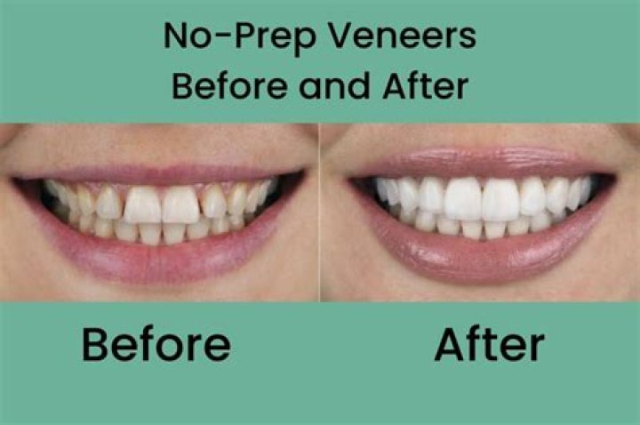How do no-prep veneers work?