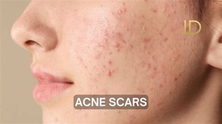 How do you fill acne pits?