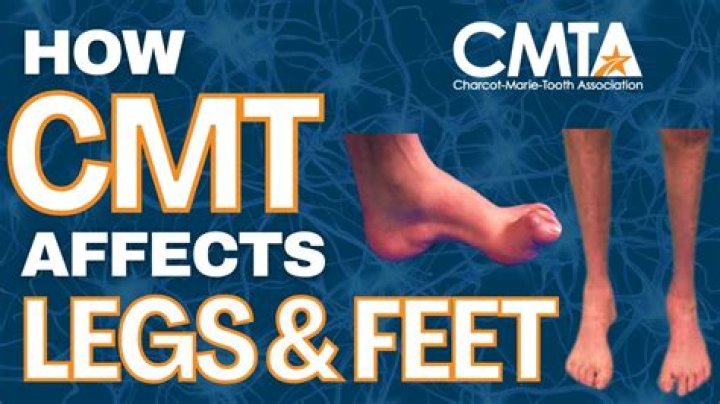 How do you get CMT disease?