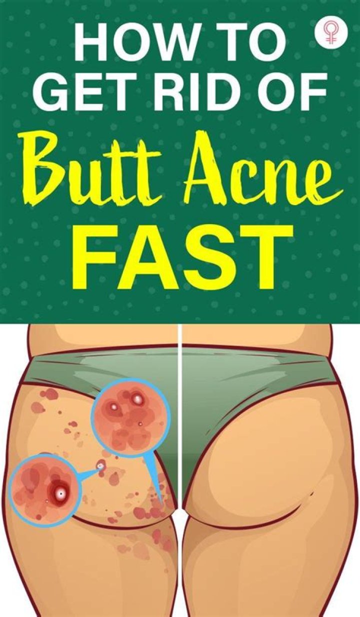 How do you get rid of butt rash in adults?