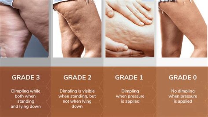 How do you get rid of Grade 3 cellulite?