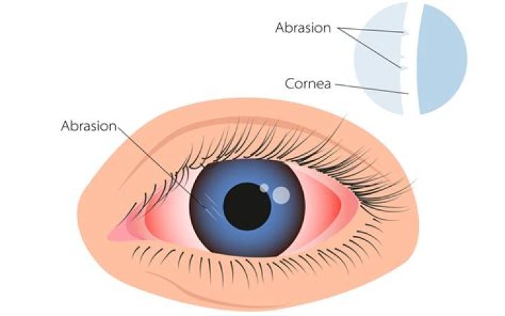 How do you know if you have damaged your cornea?