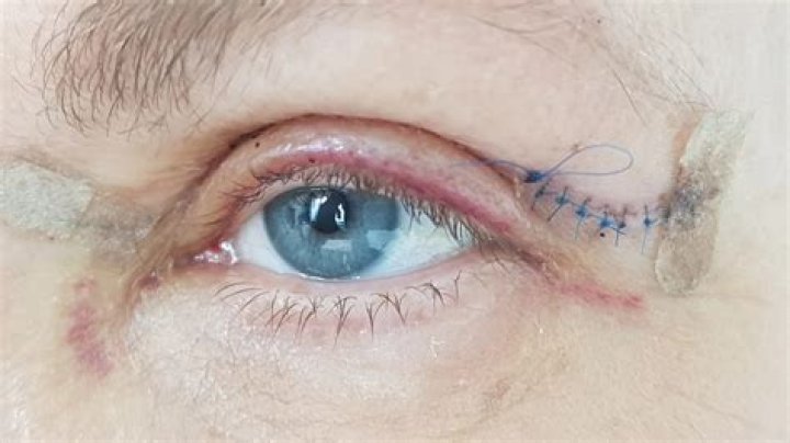 How do you know if you need Mohs surgery?