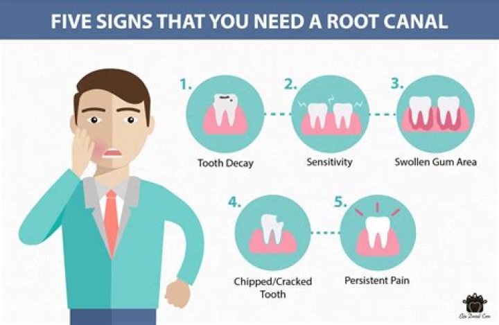 How do you know if you need root canal?