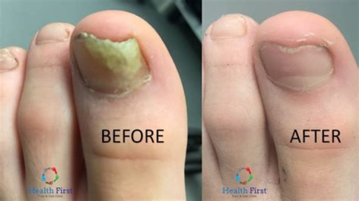 How do you know if your nail fungus is getting better?