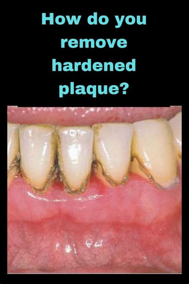 How do you remove hardened plaque?