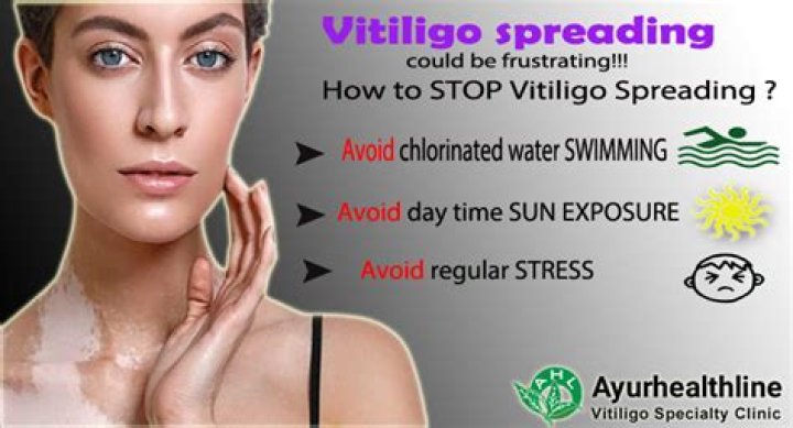 How do you stop vitiligo from spreading naturally?