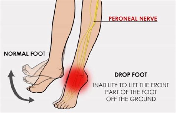 How do you treat nerve pain in your leg?