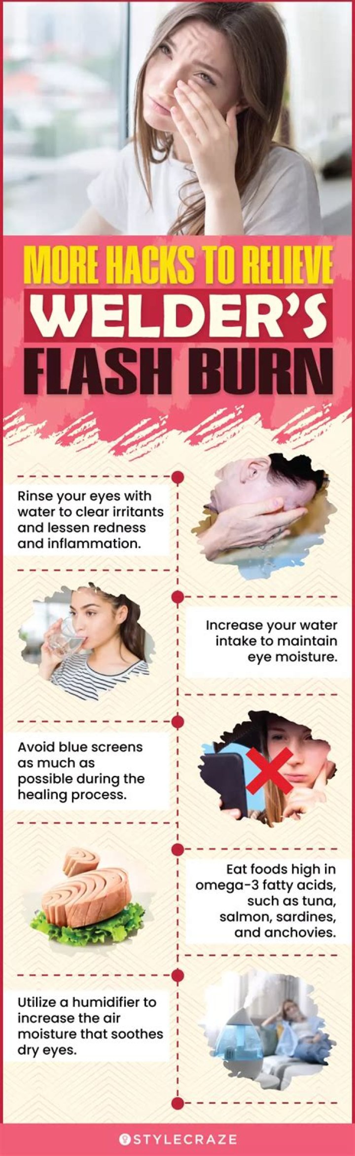 How do you treat welders flash?