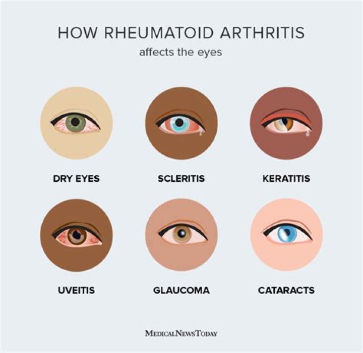How does rheumatoid arthritis affect eyes?