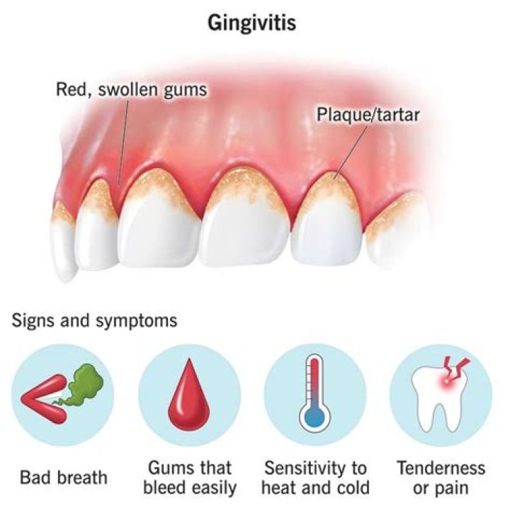 How I cured my gingivitis?