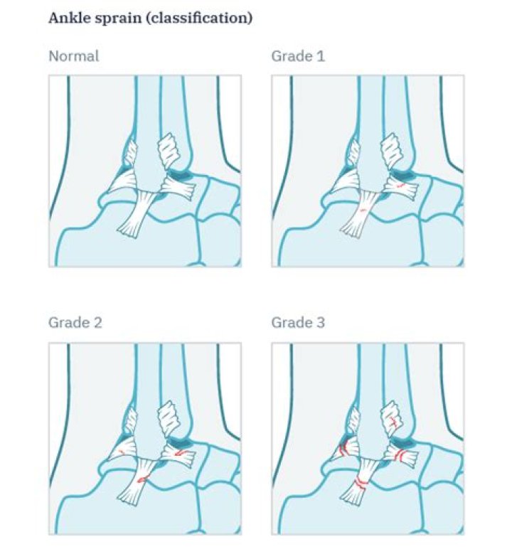How is a Grade 2 sprain treated?