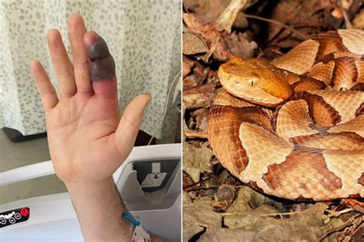 How long do you have to live after a copperhead bite?