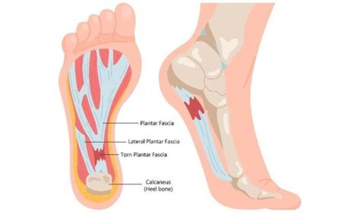 How long does a torn plantar fascia take to heal?