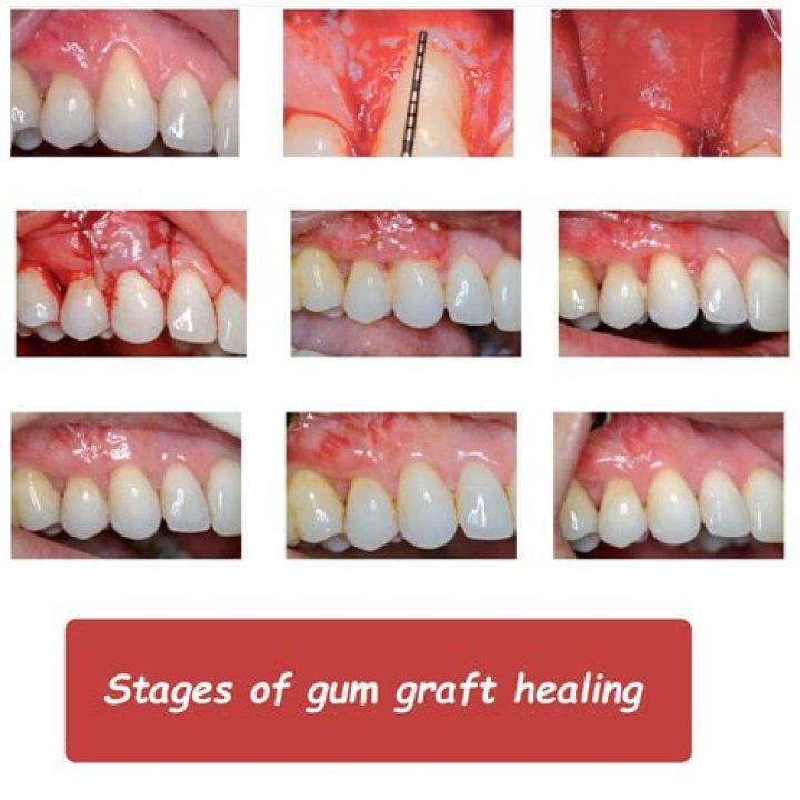 How long does it take for gums to heal after dentures?