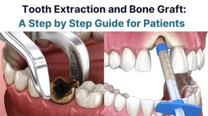 How long does pain last after tooth extraction and bone graft?