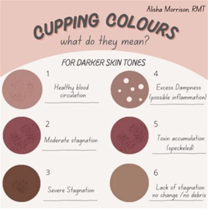 How long should cupping last?