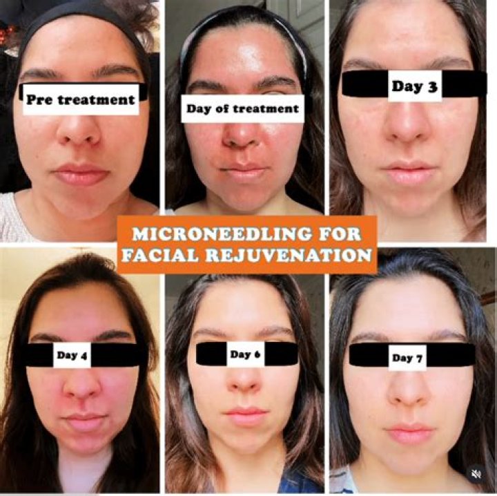 How many times a year can you do microneedling?