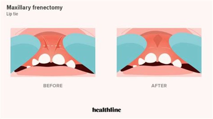 How much does a labial Frenectomy cost?