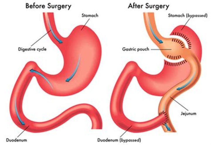 How much does gastric bypass surgery cost in Georgia?
