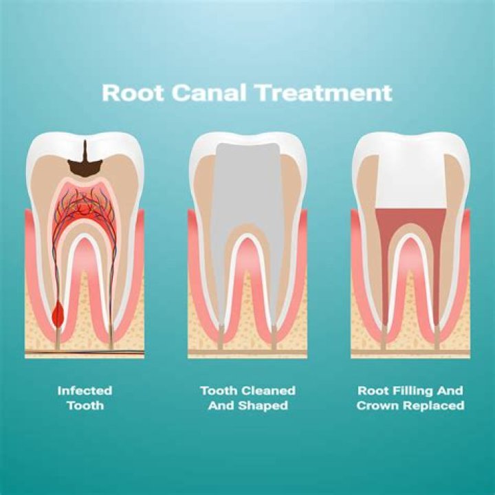 How often do root canals need to be redone?