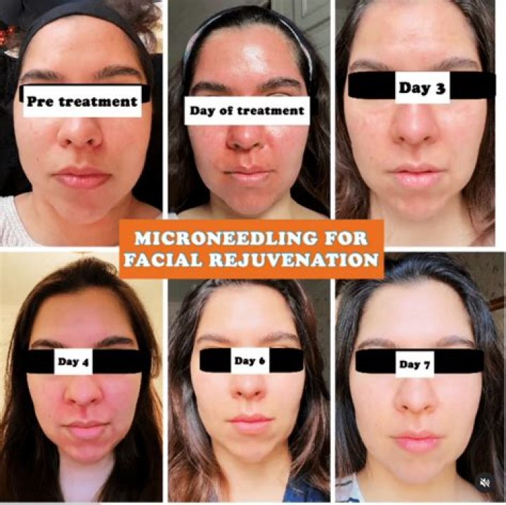 How often do you need micro needling?
