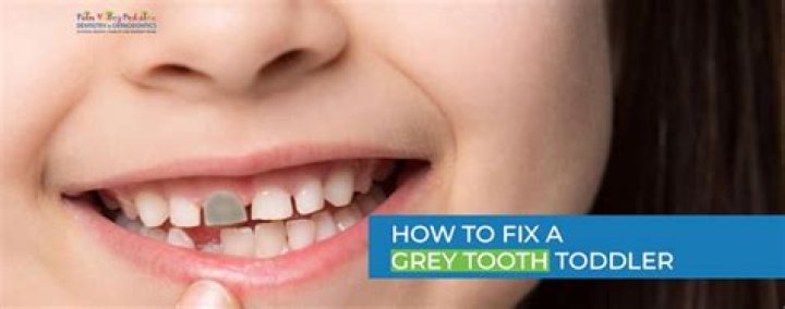 Is a tooth dead if its grey?