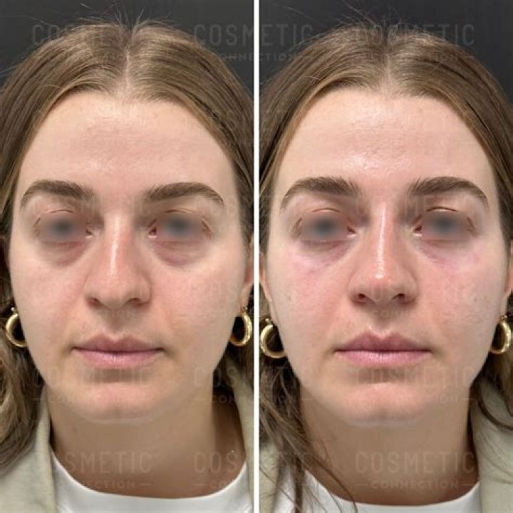 Is Botox or filler better for under-eye bags?