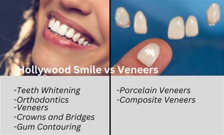 Is Hollywood smile same as veneers?