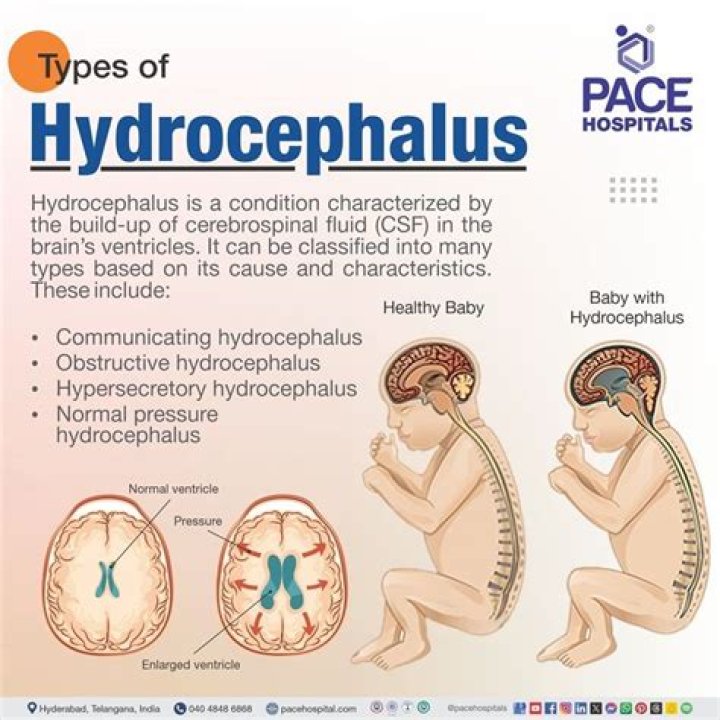 Is hydrocephalus a permanent disability?