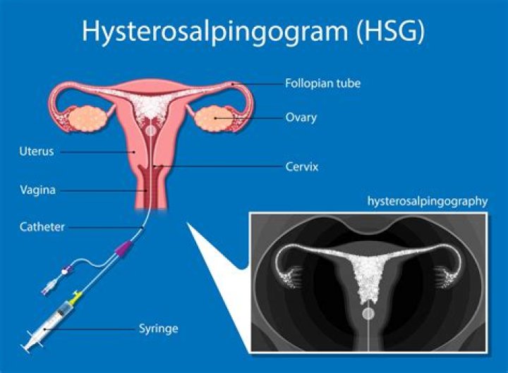 Is Hysterosalpingogram covered by insurance?