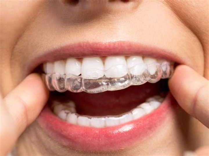 Is Invisalign permanent?