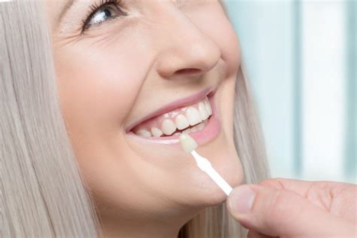 Is it easy to replace veneers?