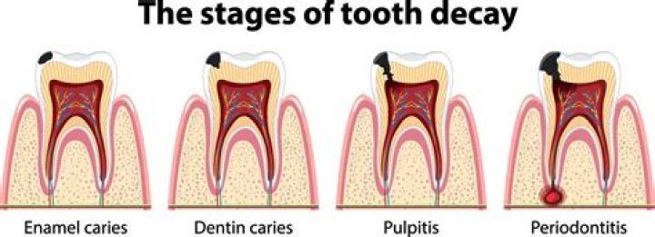 Is it worth trying to save a tooth?