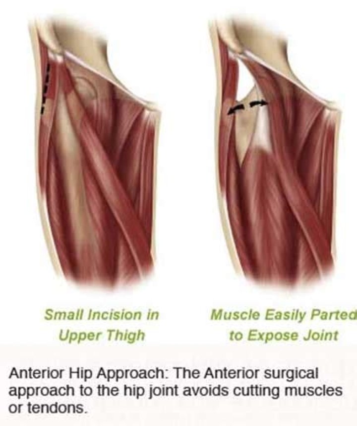 Is muscle cut during hip replacement?