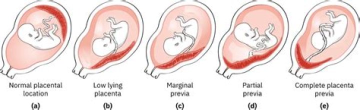 Is normal delivery possible with grade 3 placenta?