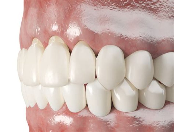 Is there a way to speed up braces?